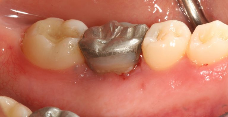 After-Crown-Lengthening-768x394-1.jpg