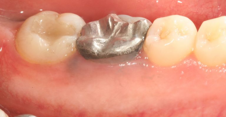 Before-Crown-Lengthening-768x400-1.jpg